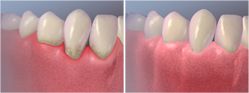 Colgajo gingival. Cirugia: antes/después.