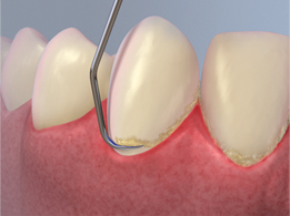 Raspado dental