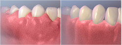 Gingivectomia: antes/después